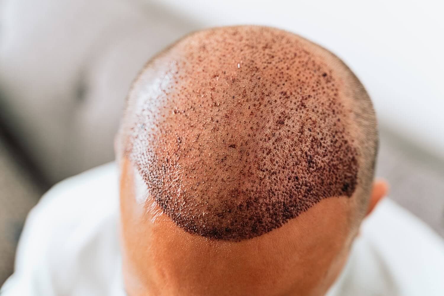 NYC Hair Replacement Designed Around You
