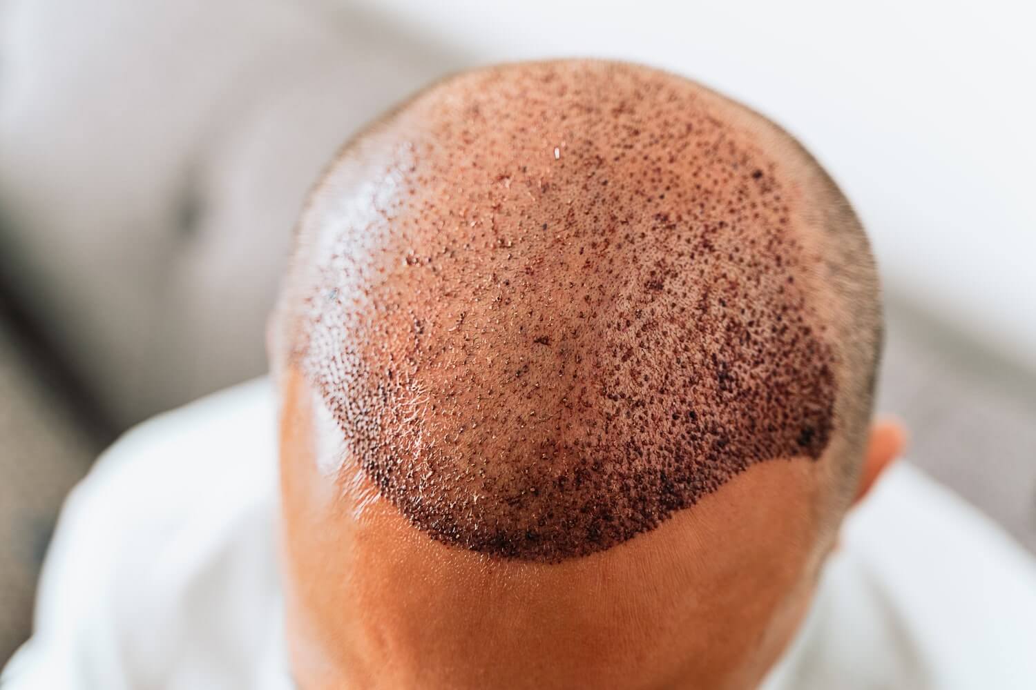 NYC Hair Replacement Designed Around You